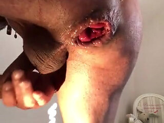 Be Careful, My Anal Prolapse Is Too Big, It Continues During My Orgasm