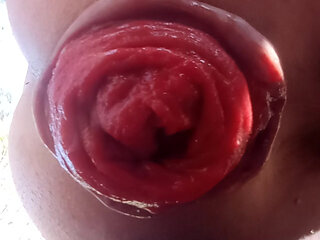 Prolapse anal