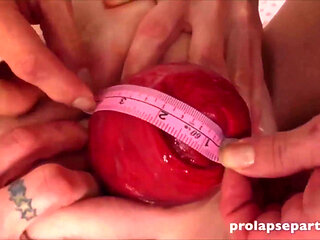 Prolapse Measure