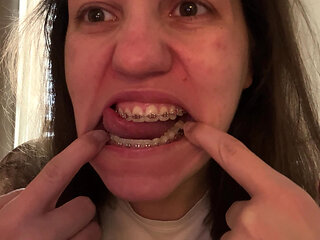 Licking Your Braces with Your Tongue