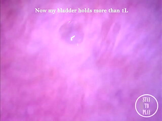 POV Endoscope Catheter Bladder Inflation!