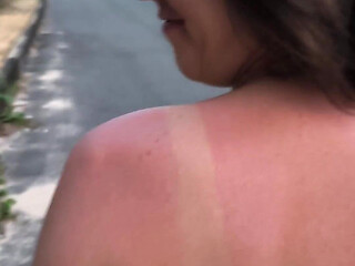 She Really Likes to Sunburn