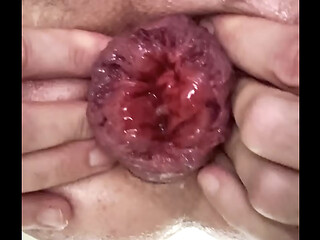 Anal whore practices rosebud and prolapse and fisting