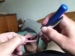 Foreskin with spoons and scissors