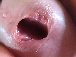 Scarred Frenulum Causes Glans Erection!