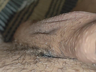 Detaching the Foreskin From the Glans Slowly.