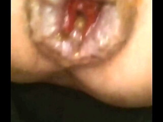 I jerk off my hemorrhoidal rose until it prolapses