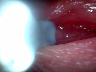 Endoscope camera captures moment of male ejaculation