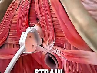 V Tone Procedure Explained