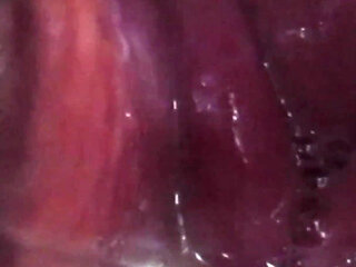 Cum Cervix Insemination