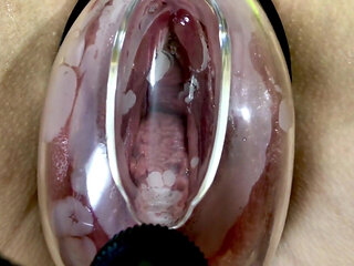 Vaginal Deformation Under the Influence of a Vacuum Pump