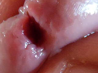 Dilation of the Glans Eye Has a Pleasant Surprise.