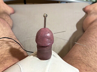 The Best Acupuncture Method!