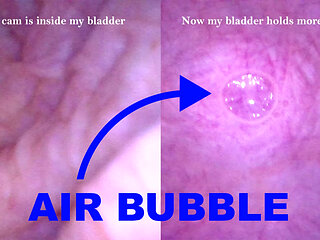 POV Endoscope Catheter Bladder Inflation