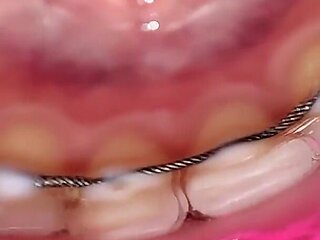 Permanent Retainers Mouth Tour
