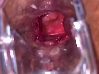 Anal Vision Speculum
